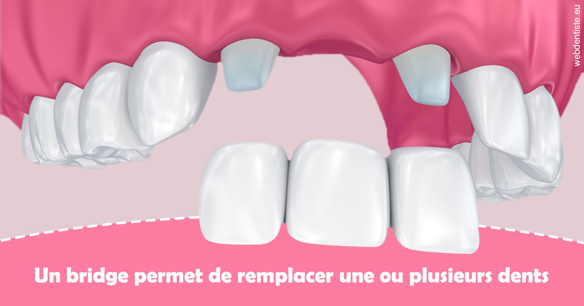 https://www.dr-dudas.fr/Bridge remplacer dents 2
