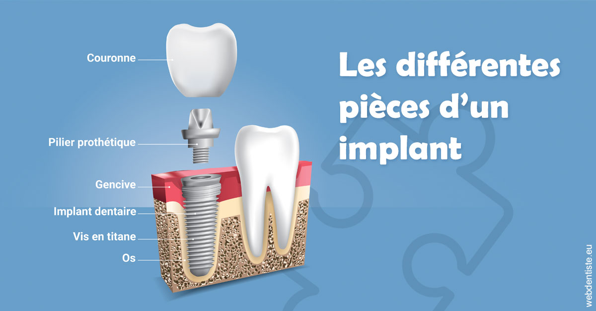 https://www.dr-dudas.fr/Les différentes pièces d’un implant 1