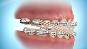 Les élastiques en orthodontie - Class III